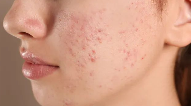 曲法罗汀对寻常痤疮治疗成功率高达67%！价格如何？